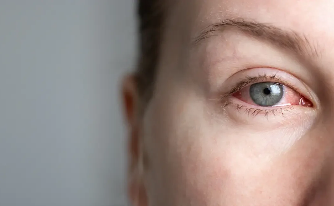 Dry Eye Treatment in Lebanon: When Artificial Tears Aren’t Enough