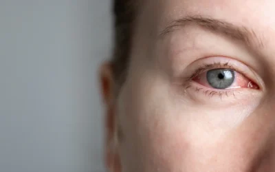 Dry Eye Treatment in Lebanon: When Artificial Tears Aren’t Enough