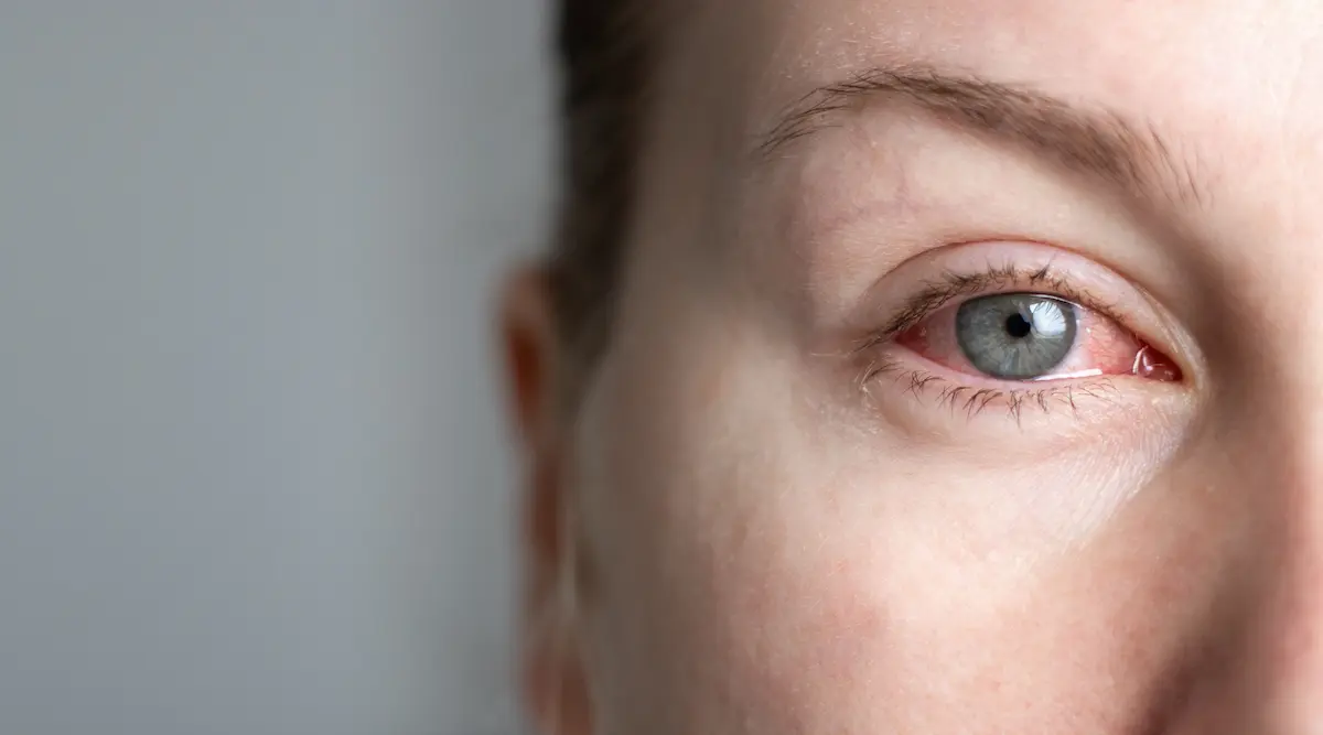 Close up of female face with one red eye suffering from dry eye