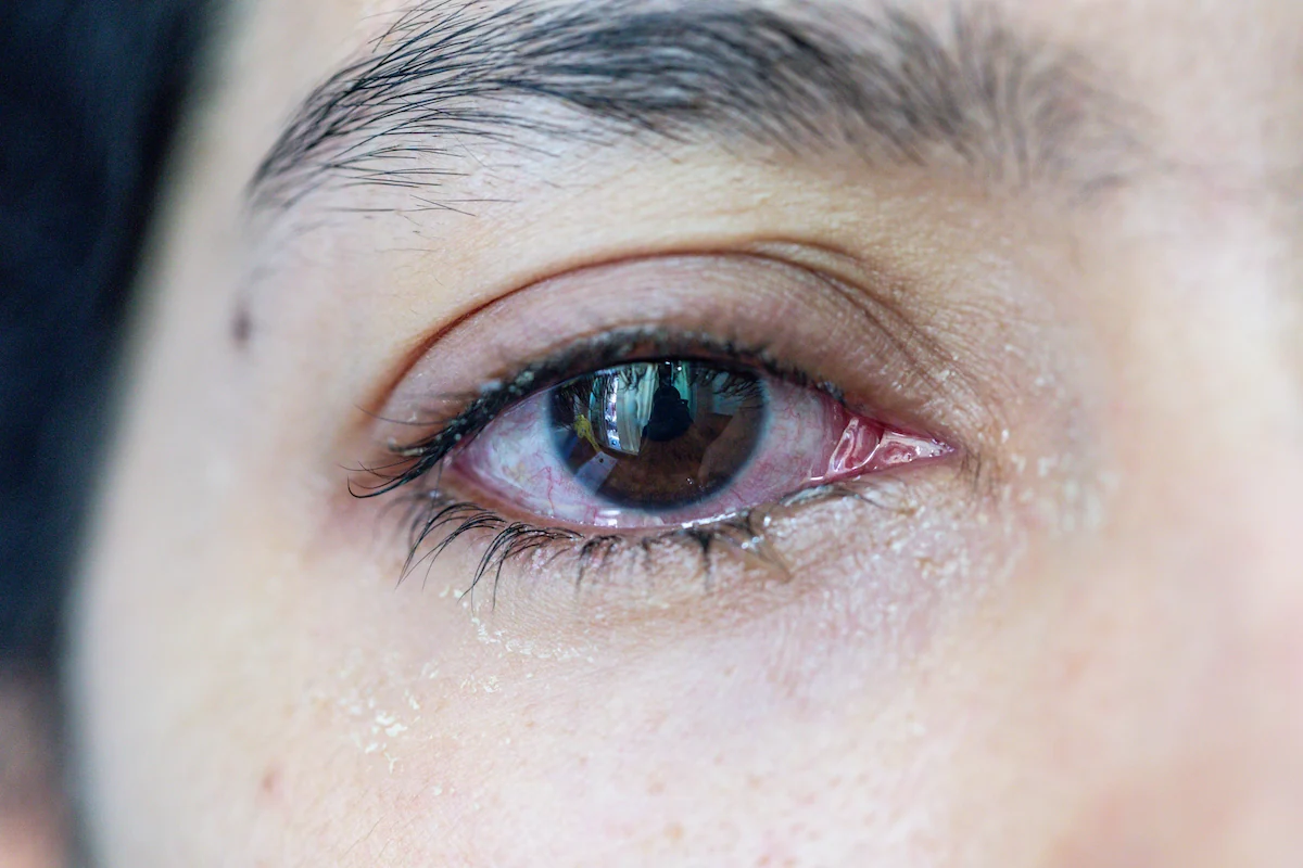 Close-up of watery bloodshot eye